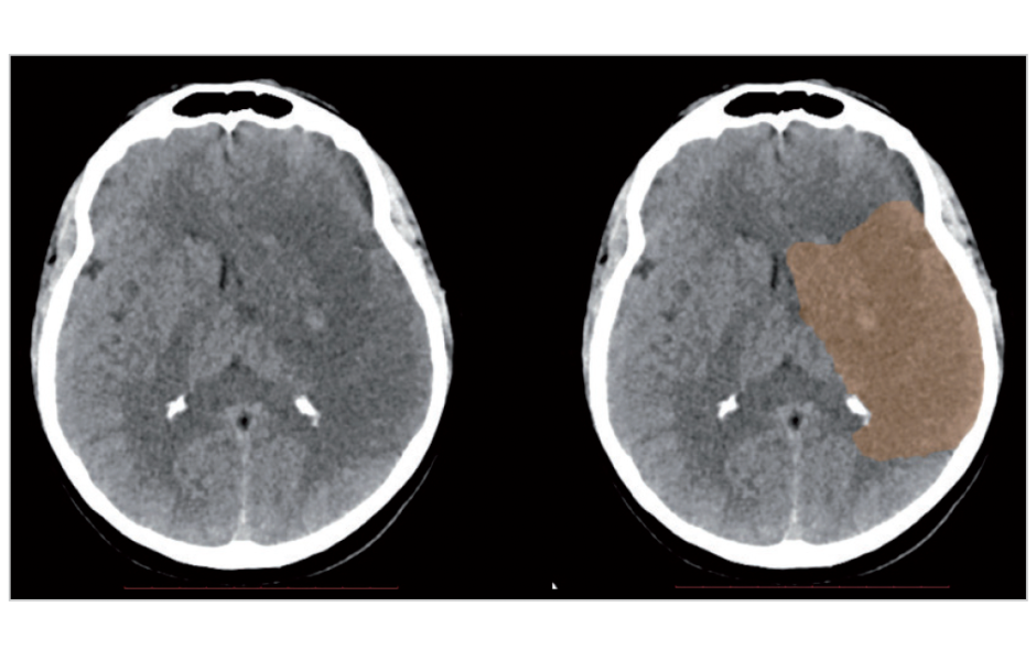CT with a hypodense area in the left hemisphere consistent with cerebral infarction