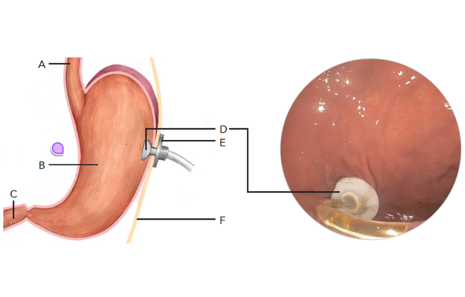Percutaneous endoscopic gastrostomy PEG tube PEG push with gastroscopic view
