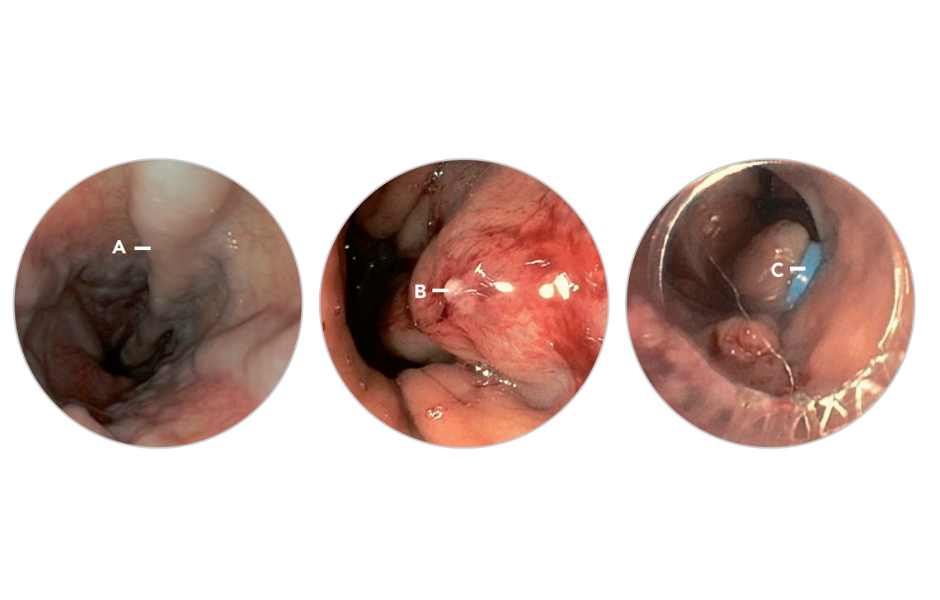 Upper endoscopy: Oesophageal varices, White nipple sign, After rubber band ligation