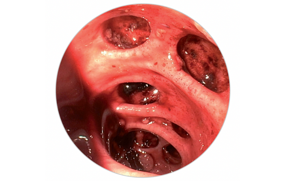 Colonoscopy aspect of colon following diverticular bleeding