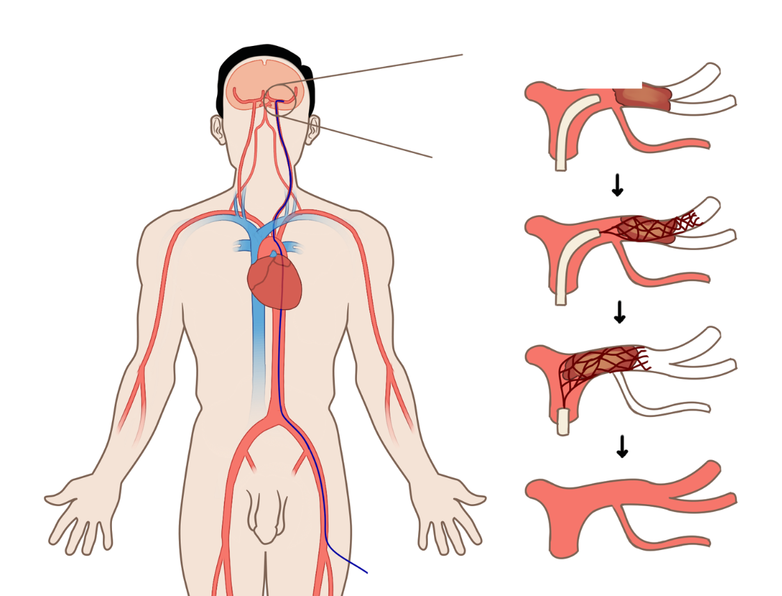 Radiology illustration from our book: Frequently performed image guided procedures