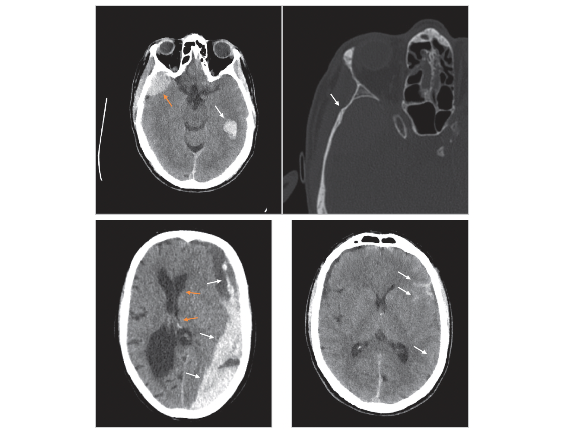 Radiology image from our book: Indicated imaging in intracranial haemorrhage