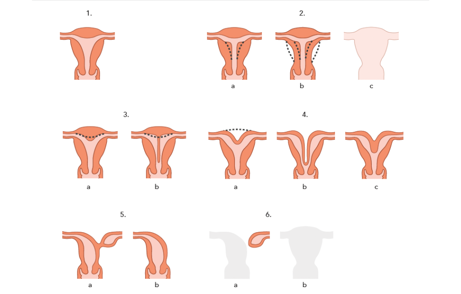 Compendium Medicine Overview of uterine anomalies
