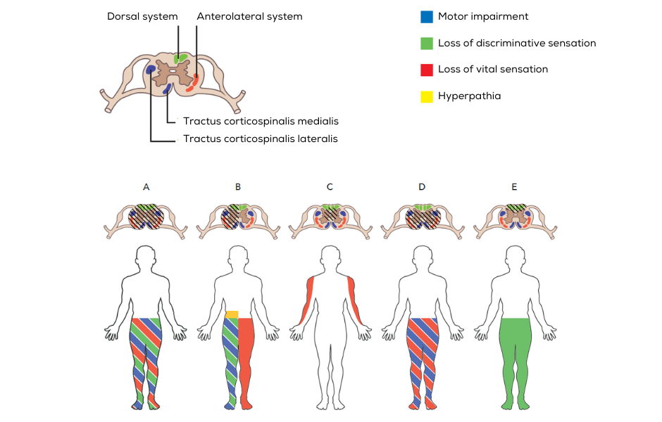 Types of spinal cord syndromes pocket Neurology
