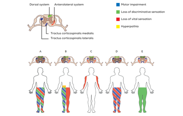 Syndrome Types. Examples Pocket Neurology – Compendium Medicine